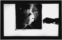 Especialistas Alertam para Doença Silenciosa e Fatal: o Aneurisma da Aorta Abdominal