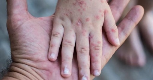 Aumentan a 50 los casos de coxsackie en Culiacán; autoridades sanitarias emiten alerta