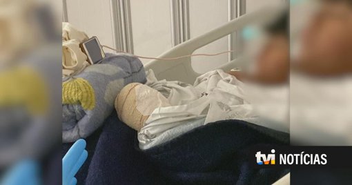 Violência escolar em Cinfães: Aluno de nove anos sofre amputação de dedos