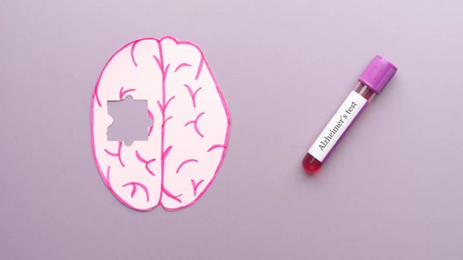 Novos Exames de Sangue Prometem Revolucionar a Deteção Precoce da Doença de Alzheimer