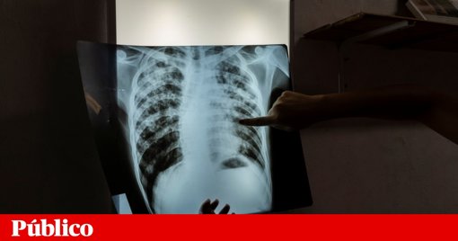 Autoridades de saúde em alerta após deteção de caso de tuberculose em hotel na região de Lisboa