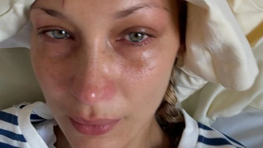 Bella Hadid Partilha Luta Contra a Doença de Lyme com Imagens Hospitalares