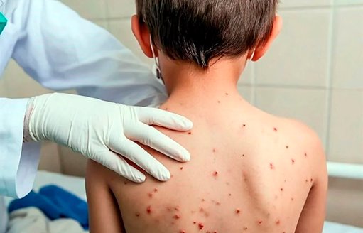 Secretaría de Salud confirma 23 muertes por brote de sarampión en México
