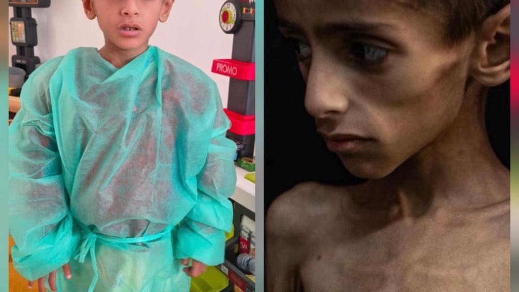 Guerra de Desinformação Intensifica-se em Torno da Fome em Gaza