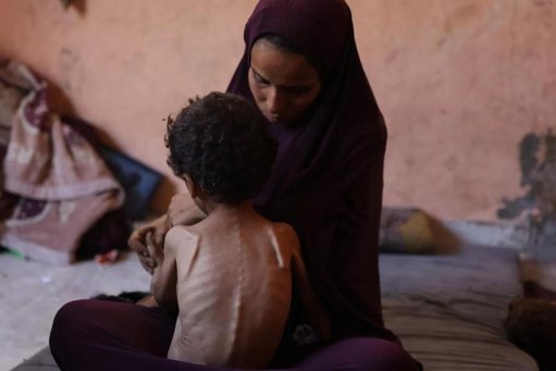 UNICEF alerta que más de 13.000 niños en Gaza sufren desnutrición aguda severa