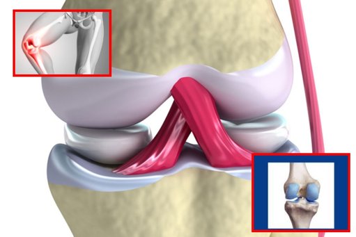 Crean un cartílago artificial que imita la flexibilidad y resistencia del tejido humano