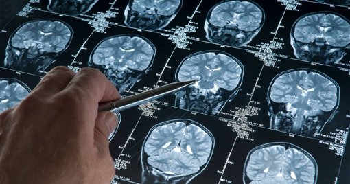 Estudo redefine as fases do cérebro e prolonga a adolescência até aos 32 anos